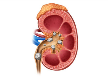 Tips to Prevent Kidney Stones