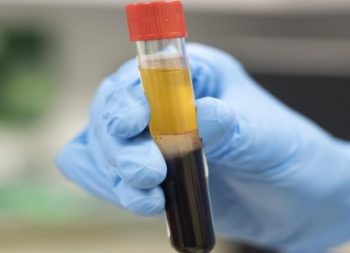 Plasma Therapy for Coronavirus Treatment