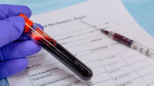 liver function test in udaipur